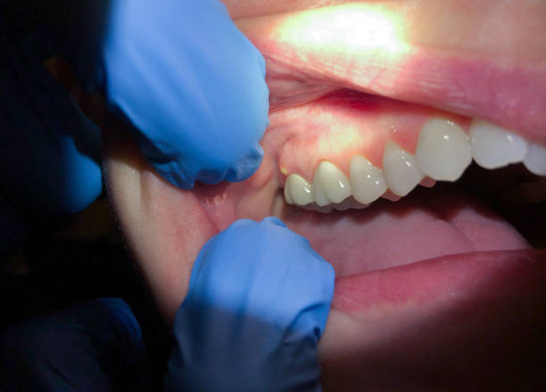 Best Emergency Tooth Extraction in Dahlone, GA