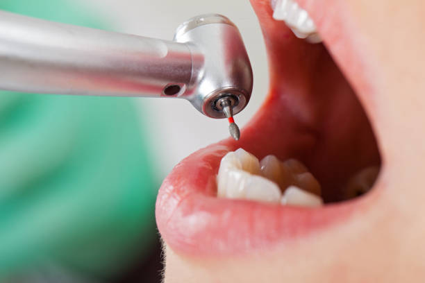 Best Emergency Wisdom Teeth Removal in Dahlone, GA